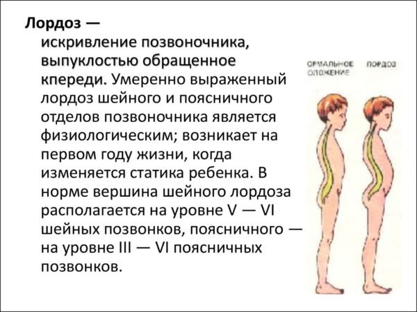 Что такое сколиоз у детей и как его вылечить?