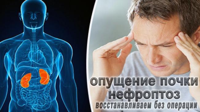 Стадии развития нефроптоза правой почки: симптомы, лечение и предупреждение заболевания