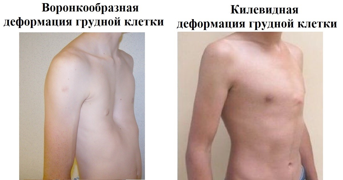 Искривление позвоночника у грудничка причины и лечение