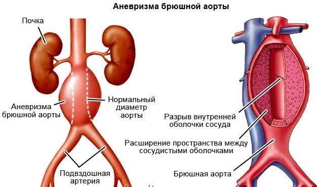 Каковы признаки аневризмы брюшной аорты?
