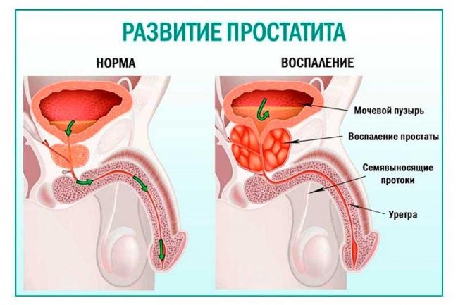 Воспаление простаты у мужчин: симптомы, причины, лечение