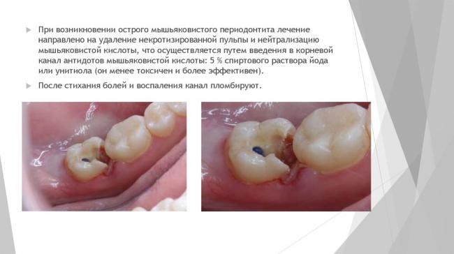 Симптомы и лечение пульпита