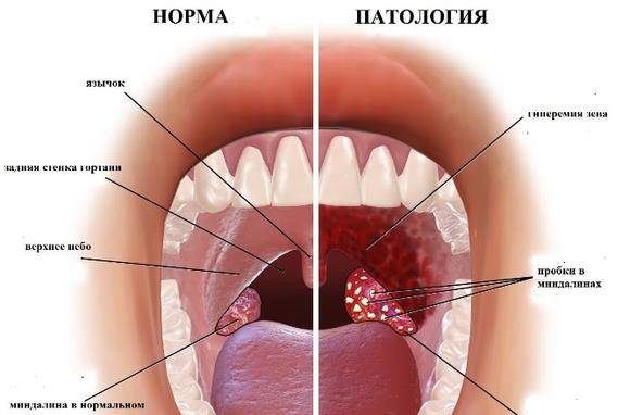 Воспаление глоточной миндалины у взрослых симптомы. принципы лечения бактериальной инфекции. что нужно делать во время воспаления гланд