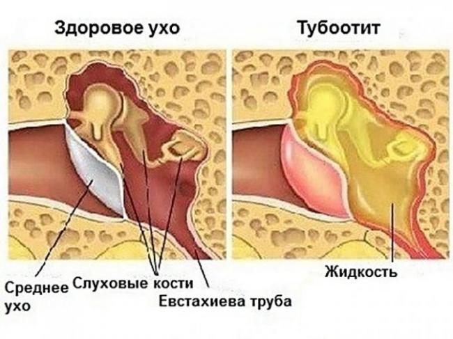 Тубоотит – симптомы, лечение, причины, виды, прогноз