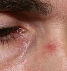 Удаление сосудов на лице лазером: отзывы, описание процедуры, противопоказания. купероз на лице: причины и лечение