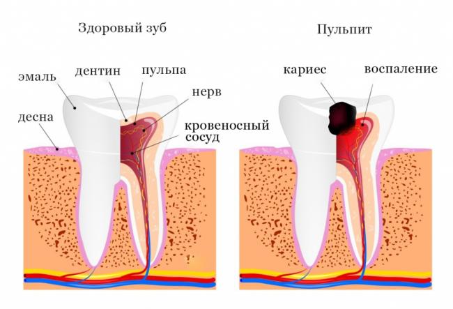 Обострение хронического пульпита, стадии, лечение