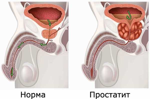 Почему возникает и как лечить воспаление простаты у мужчин