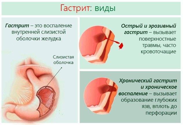 Чем трахеит отличается от фарингита