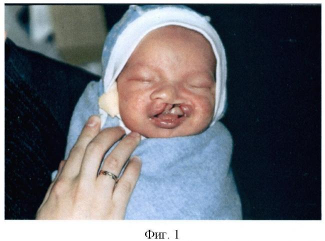 Заячья губа и волчья пасть - cleft lip and cleft palate - qwe.wiki