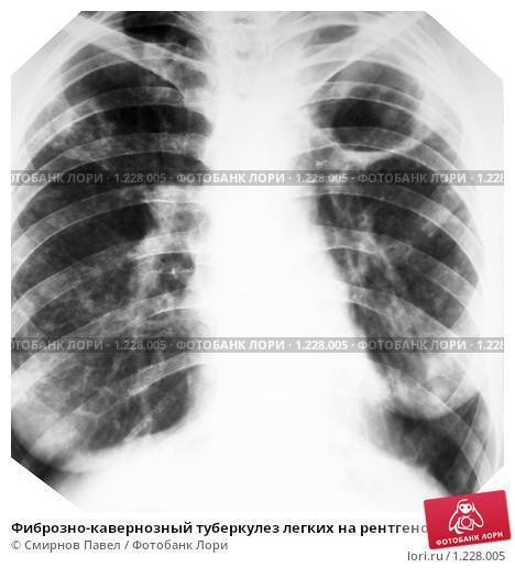 Кавернозный туберкулез