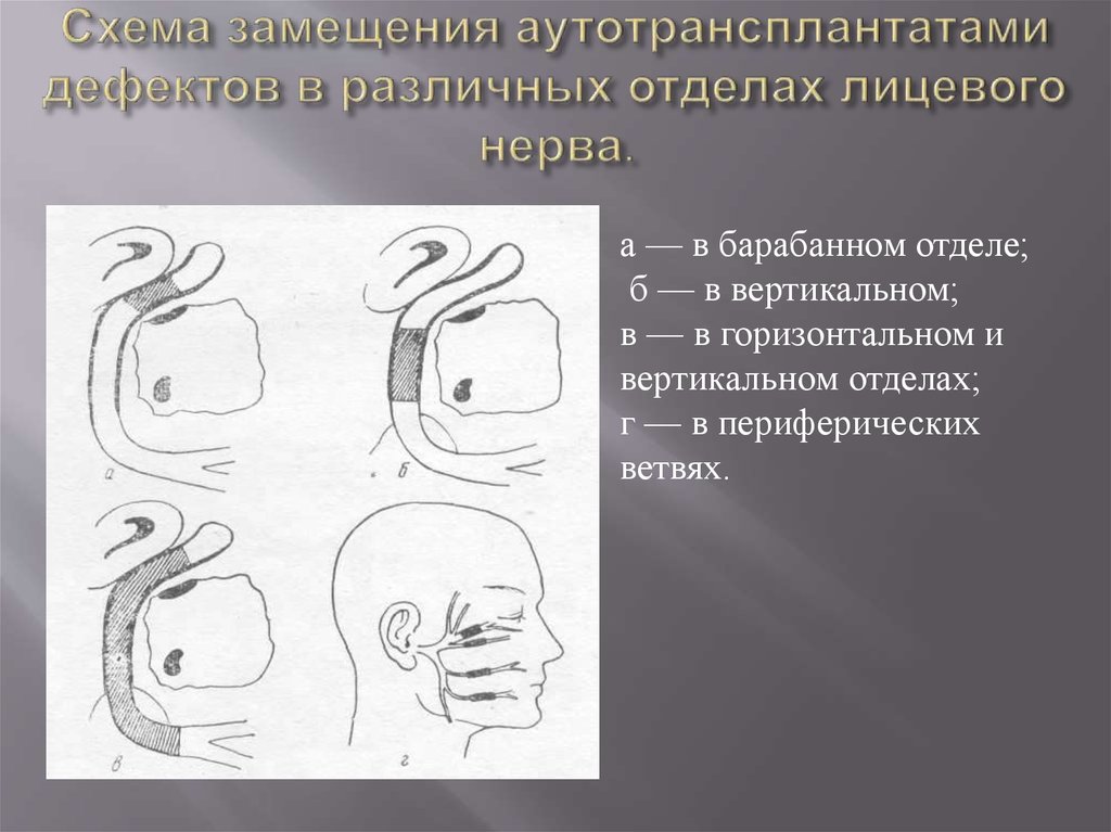 Воспаление тройничного нерва