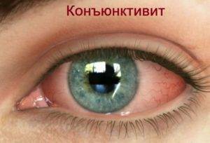 Катаракс , Капли глазные