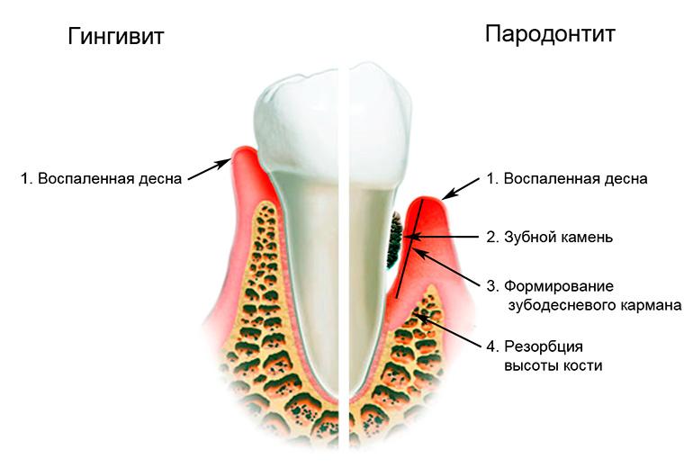 Кровят десны что делать народные средства