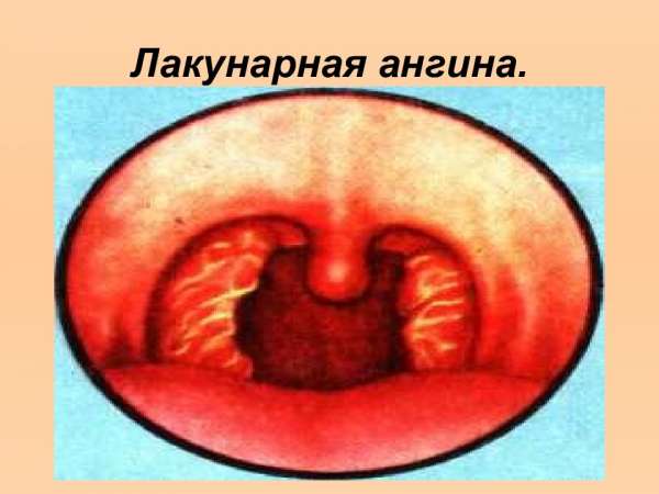 Как лечить гнойную ангину в домашних условиях