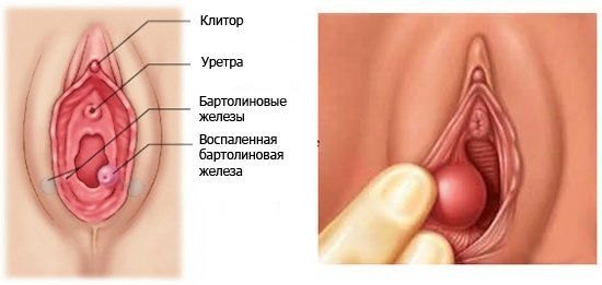 Абсцесс бартолиновой железы: лечение, операция, причины, фото