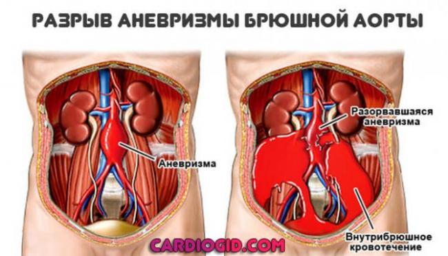 Аневризма аорты брюшной полости