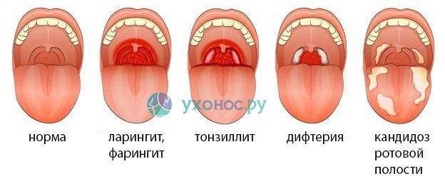 Болит горло и шея и больно глотать