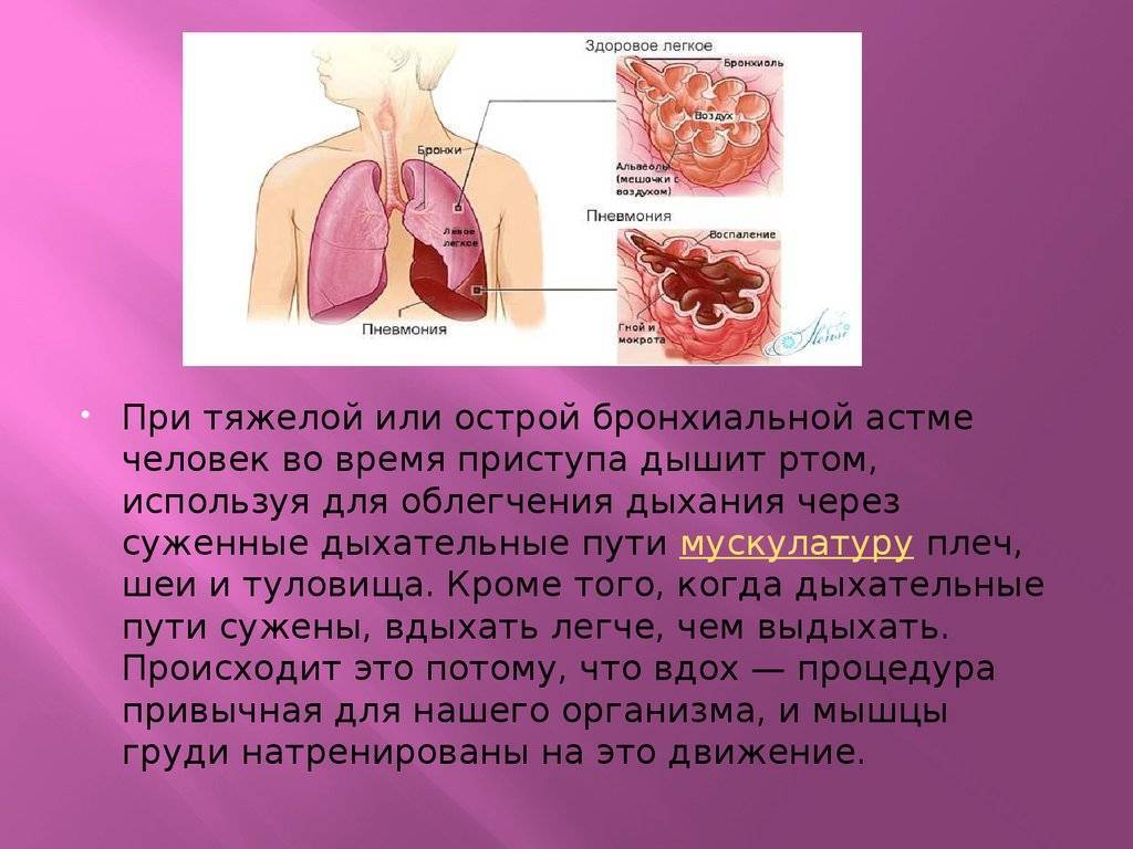 Кашель с гноем при астме