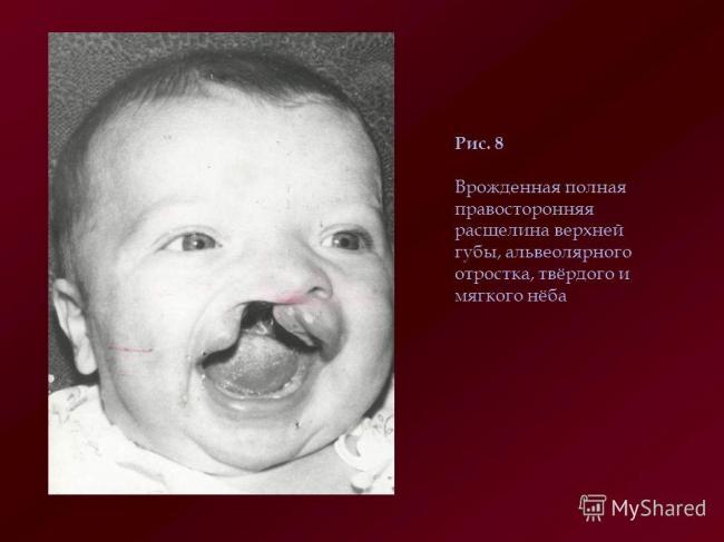 Прогноз к нормальной жизни у детей с волчьей пастью