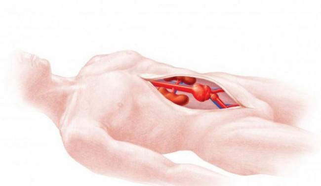Аневризма аорты брюшной полости: симптомы, причины, лечение, виды аневризмы, операция