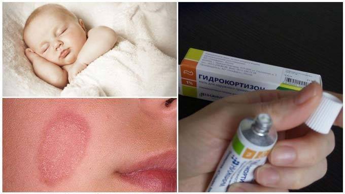 Гидрокортизон
(hydrocortisone)