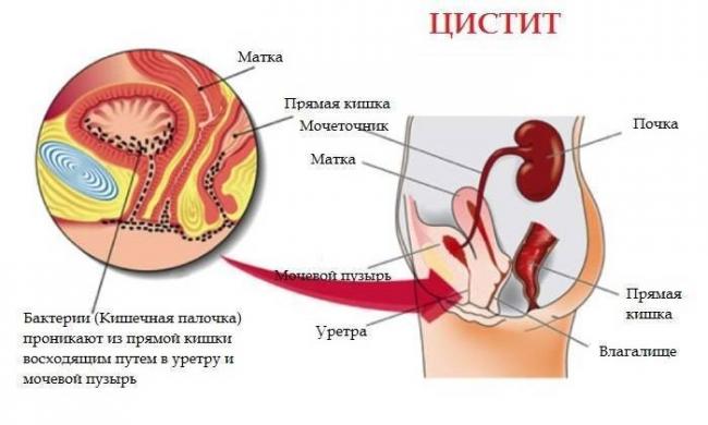 Кишечная палочка (escherichia coli, эшерихиоз): лечение, симптомы, бактерии группы, что убивает кишечную палочку, как она передается
