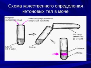 Ацетон в моче у ребенка – о чем говорит наличие кетонов?