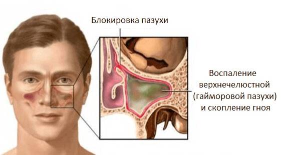 Гнойный гайморит: лечение в домашних условиях, симптомы, что делать