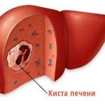 Что такое объемное образование печени на УЗИ?