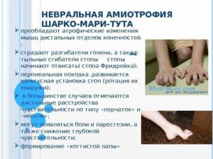 Невральная амиотрофия шарко–мари–тута симптомы, лечение, профилактика, причины заболевания
