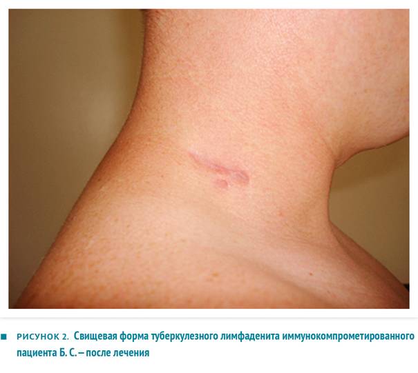 Туберкулез лимфоузлов