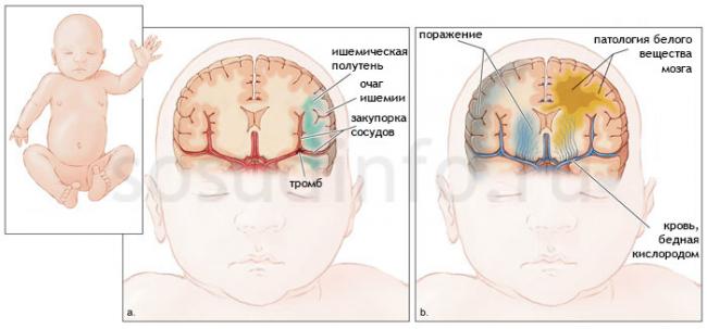 Гипоксия плода: последствия для ребенка