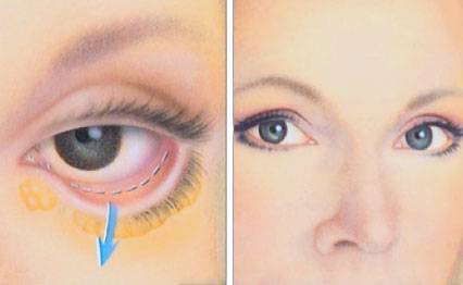 Провисание нижнего века после блефаропластики