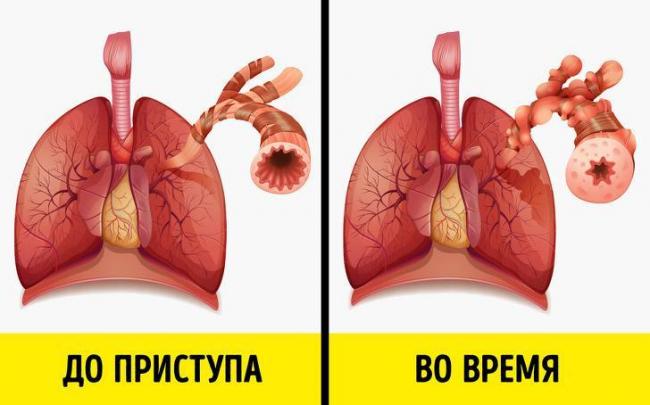 Причины и лечение хрипов в бронхах