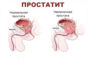 Острый и хронический простатит: признаки, симптомы и лечение