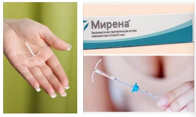Спираль мирена: отзывы и инструкция