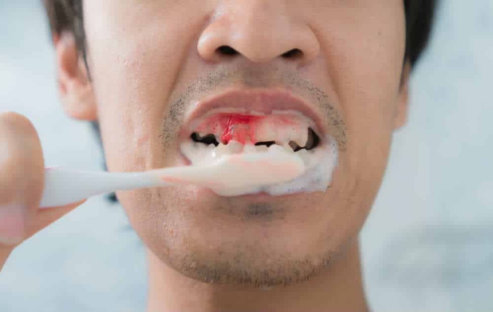 5 способов устранить кровоточивость десен