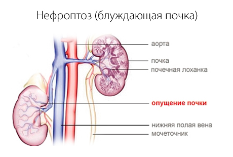 Нефроптоз почки — что это такое, последствия болезни, симптомы и лечение