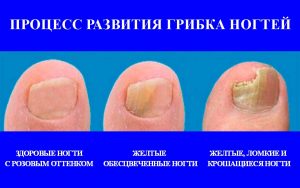 Димексид инструкция по применению