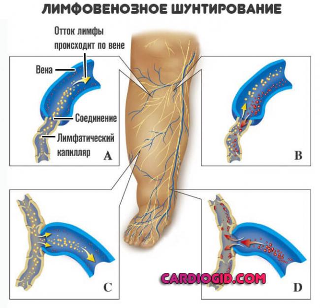 Лимфостаз нижних конечностей: причины и особенности лечения