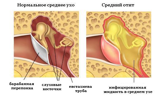 Самые эффективные антибиотики для детей при отите
