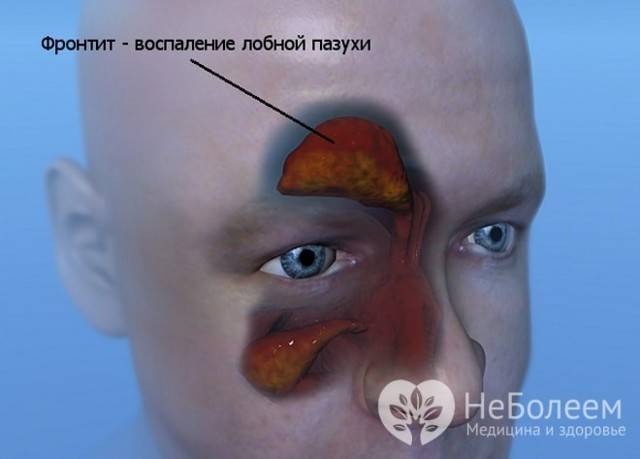 Лечим фронтит быстро в домашних условиях