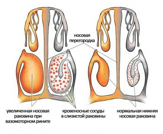 Болезни носа и околоносовых пазух.насморк (ринит).