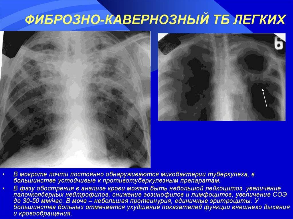 Кавернозный туберкулез легких