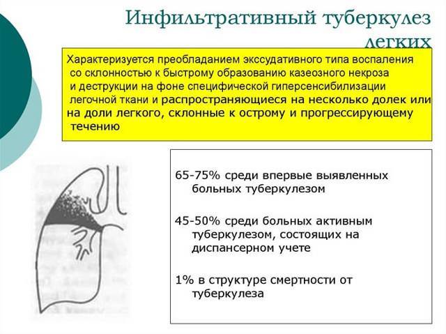 Инфильтративный туберкулез: причины, симптомы, лечение, прогноз