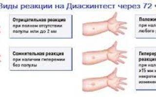 Диаскинтест или манту – что лучше, в чем разница? чем отличается манту от диаскинтеста?