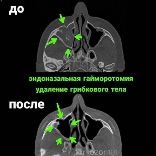 Лечение хронического гайморита у взрослых