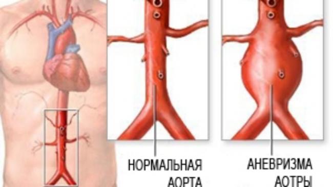 Аневризма брюшной аорты – симптомы, лечение, операция, разрыв