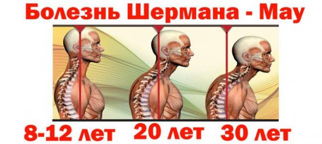 Юношеский кифоз или заболевание шейермана-мау