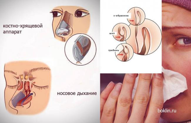 Эффективное лечение хронического атрофического ринита